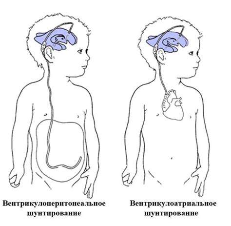 Прогноз и осложнения невыраженной гидроцефалии