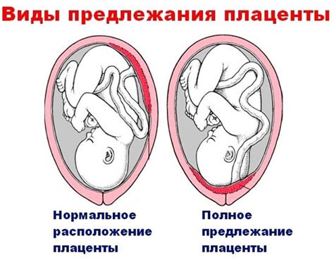 Прогноз и последствия краевого расположения хориона