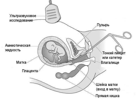 Прогноз и предупреждение хориона кругового