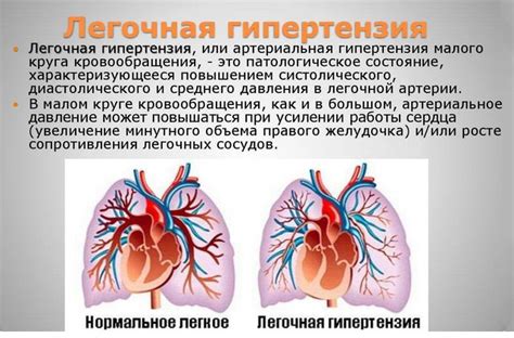 Прогноз и профилактика легочной гипертензии