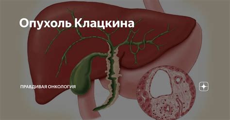 Прогноз и профилактика опухоли Клацкина тип 3а