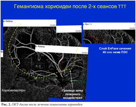 Прогноз и рекомендации после лечения гемангиомы