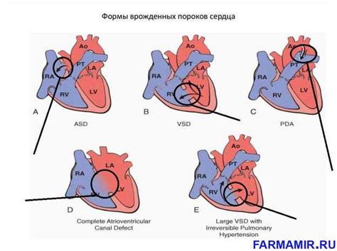 Прогноз при незначительном пороке сердца