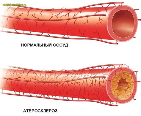 Проницаемость сосудов: что это значит?