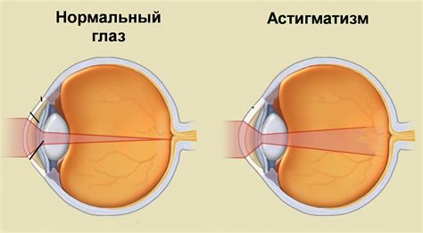 Простой миопический астигматизм