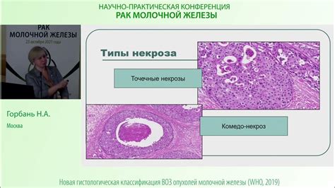 Протоковый рак молочной железы G2