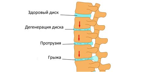 Протрузия