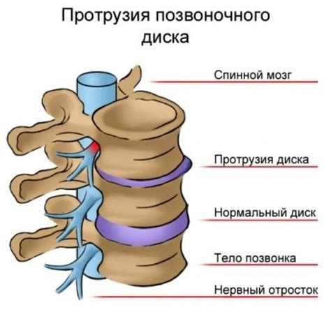 Протрузия позвоночных дисков