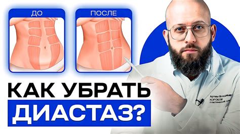 Профессиональные методы лечения диастаза