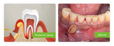 Профессиональные методы лечения свища над зубом