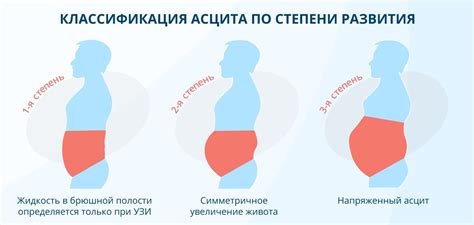 Профилактика воды в брюшной полости