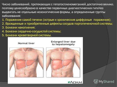 Профилактика гепатомегалии печени