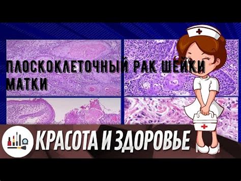 Профилактика гиперкератоза плоского эпителия