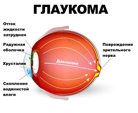 Профилактика глаукомы: рекомендации по сохранению зрения