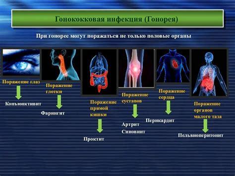 Профилактика гонококковой инфекции