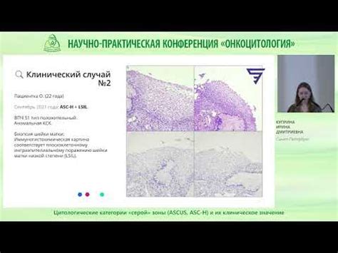 Профилактика и лечение нерезко выраженных изменений клеток плоского эпителия