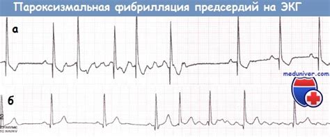 Профилактика и реабилитация после лечения фибрилляции предсердий тахисистолической формы