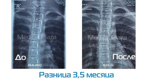 Профилактика и реабилитация сколиоза мэн