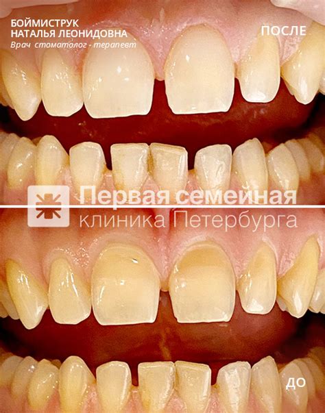 Профилактика клиновидных зубов