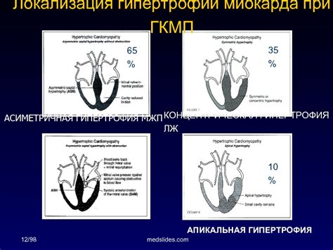 Профилактика незначительной гипертрофии МЖП