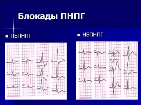 Профилактика неполной блокады правой ножки у детей