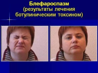 Профилактика непроизвольного мигания