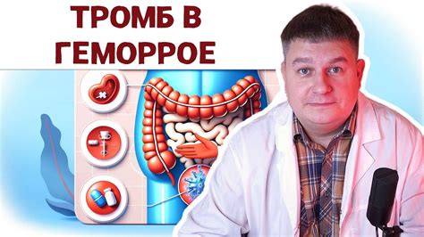 Профилактика острого геморроя