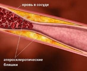 Профилактика повышенного холестерина