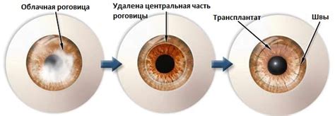 Профилактика помутнения роговицы глаза