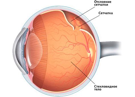 Профилактика порванной сетчатки глаза