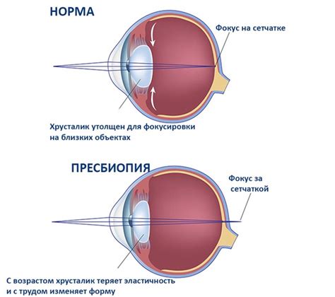 Профилактика пресбиопии глаз