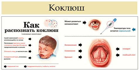 Профилактика распространения коклюша