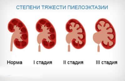 Профилактика расширенной почечной лоханки