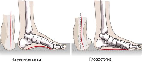 Профилактика уплощения стоп