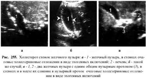 Профилактика утолщения междолькового интерстиция