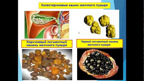 Профилактика флегмонозного калькулезного холецистита