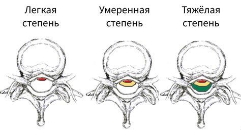 Профилактика циркулярного выбухания диска L5 S1