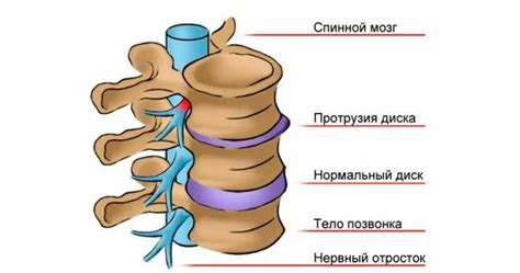 Профилактика экструзии дисков шейного отдела позвоночника