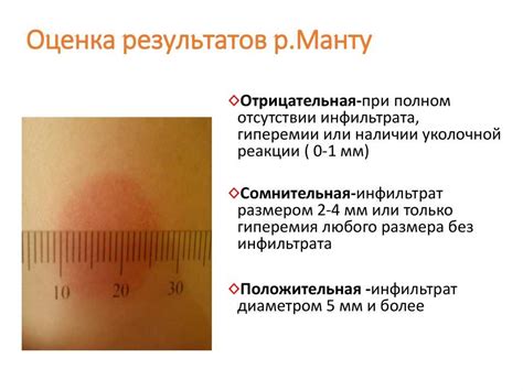 Процедура манту и ее значения: основные аспекты