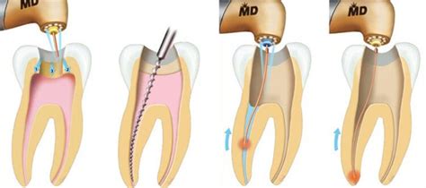 Процедура чистки каналов зуба: основные шаги