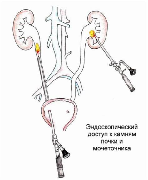 Процедуры разрушения и удаления камней