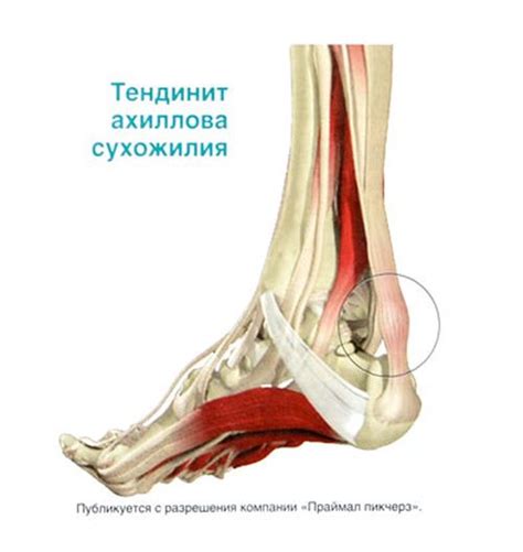 Процесс диагностики тендинита