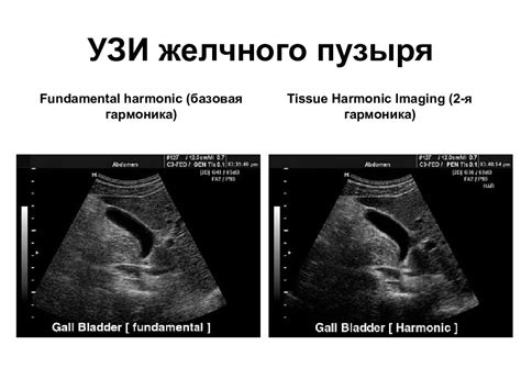 Процесс проведения УЗИ желчного пузыря с нагрузкой