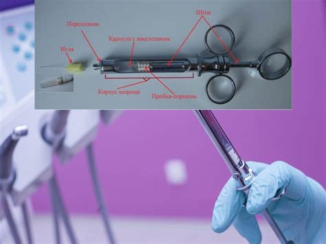 Процесс проведения местной анестезии: шаги и правила безопасности