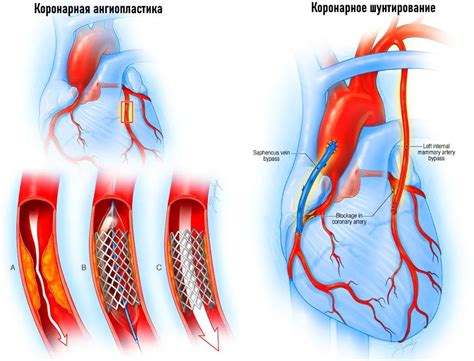 Процесс проведения стентирования сосудов сердца