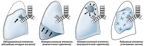 Процесс развития тотального ателектаза легкого