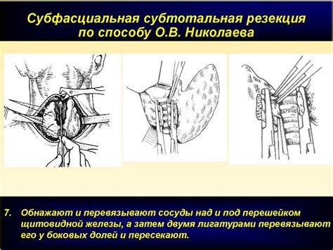 Процесс субтотальной резекции щитовидной железы