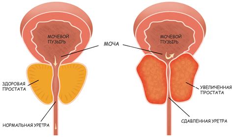 Процесс увеличения предстательной железы и его эффекты