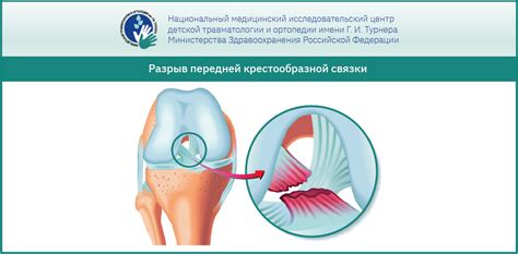 Проявления отсутствия смазки в коленном суставе