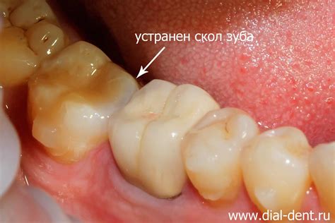 Психологическое значение мечты о потерянном осколке зуба